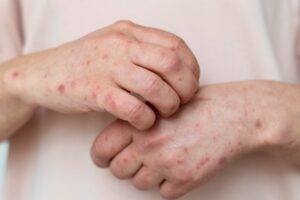 La Secretaría de Salud confirma un nuevo caso de sarampión en Nuevo León, sumando preocupaciones sobre la salud pública.