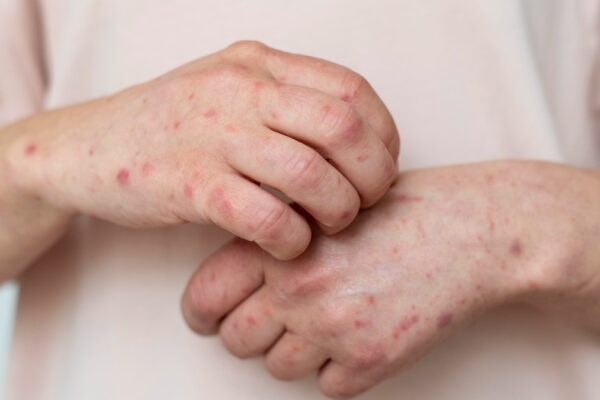 La Secretaría de Salud confirma un nuevo caso de sarampión en Nuevo León, sumando preocupaciones sobre la salud pública.